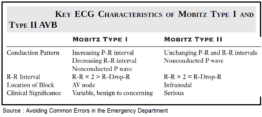 Key ECG Characteristics of Mobitz Type I and Type II AVB