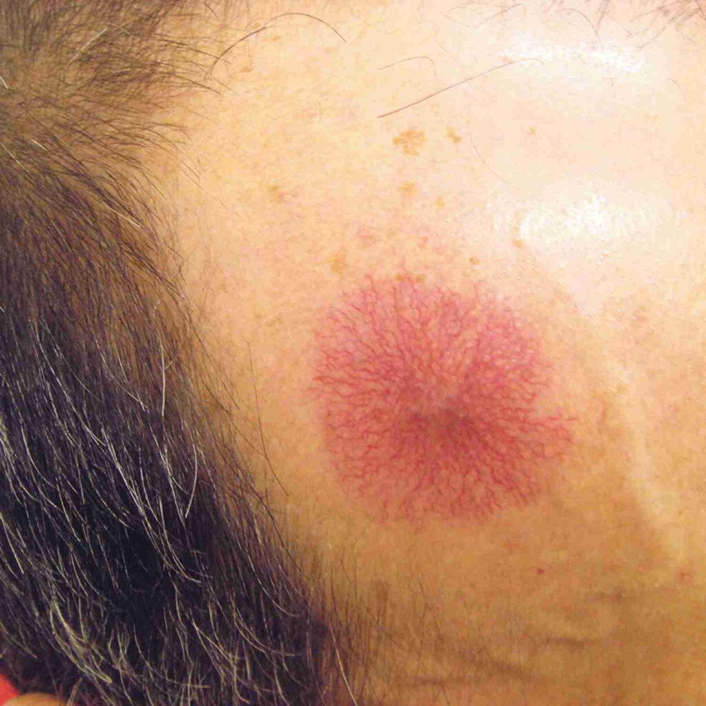 Neovascular Lesion on Face