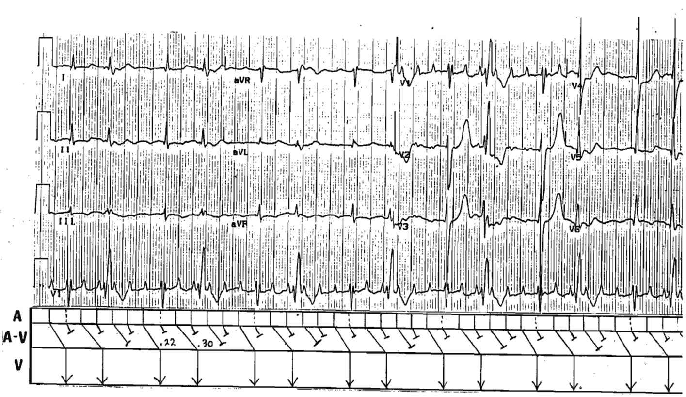 Atrial Flutter with 3:2 and 2:1 Conduction