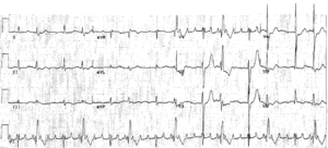 Read more about the article ECG Case 23