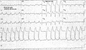 Read more about the article Inferior and Right Ventricular MI with Second Degree Type I AV Block (Wenckebach)