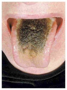 Read more about the article Black Discoloration of the Tongue