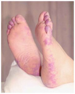 Read more about the article Bluish Discoloration of the Toes with Livedo Reticularis