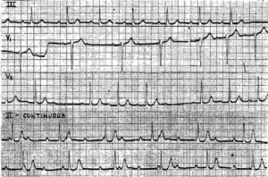 Read more about the article First, Second and Third Degree AV Block in the Same Patient