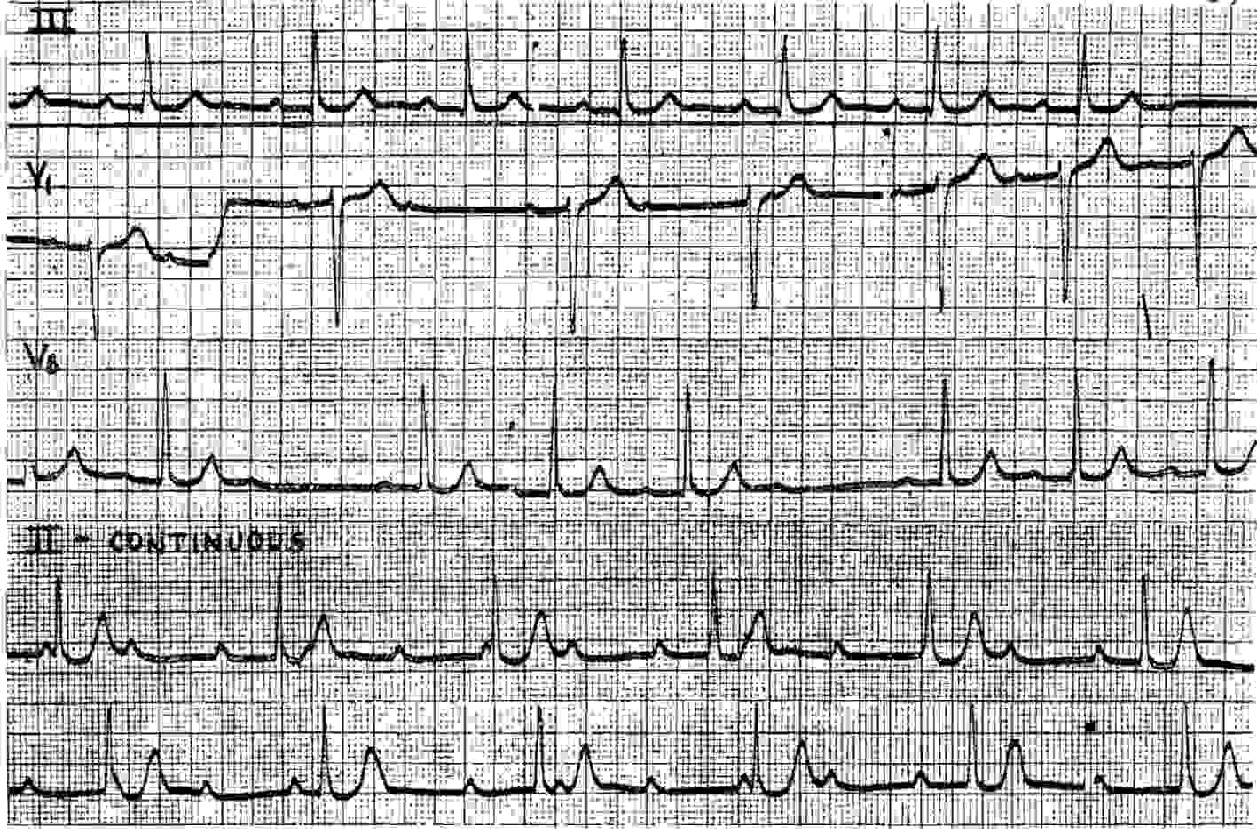 Read more about the article ECG Case 21
