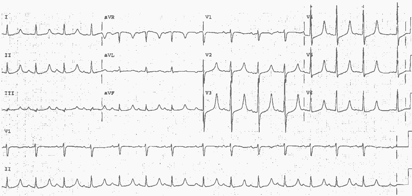 Read more about the article ECG Case 22