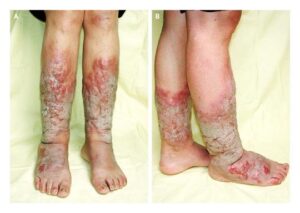 Read more about the article Pretibial Hyperkeratosis, Fissuring, and Verrucous Nodules