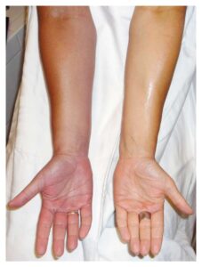 Read more about the article Swelling and Red Discoloration of the Right Arm and Hand