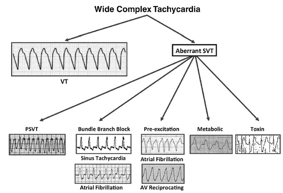 The differential diagnosis of Wide Complex Tachycardia