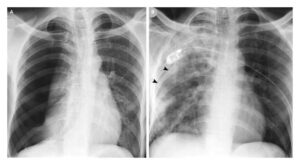 Read more about the article Reexpansion Pulmonary Edema after Treatment of Pneumothorax