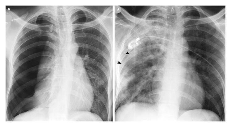 Read more about the article A 50-year-old Smoker with Acute Breathlessness and Right-sided Chest Pain