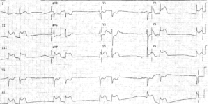 Anterior-Inferior-Posterior MI - Manual of Medicine