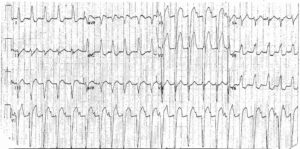 Read more about the article ECG Case 26