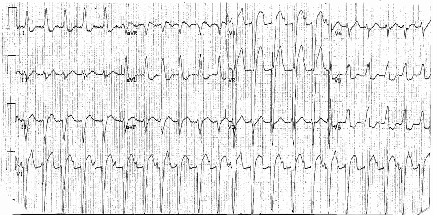 Read more about the article ECG Case 26