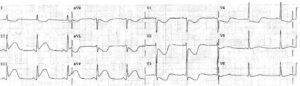 Read more about the article ECG Case 27