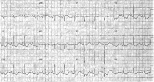 Read more about the article ECG Case 28