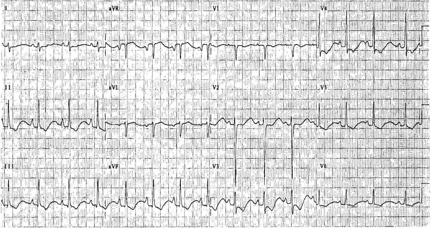 ECG of Hypokalemia with down-up T waves, long QT interval and U waves due to Anorexia Nervosa and Diarrhea