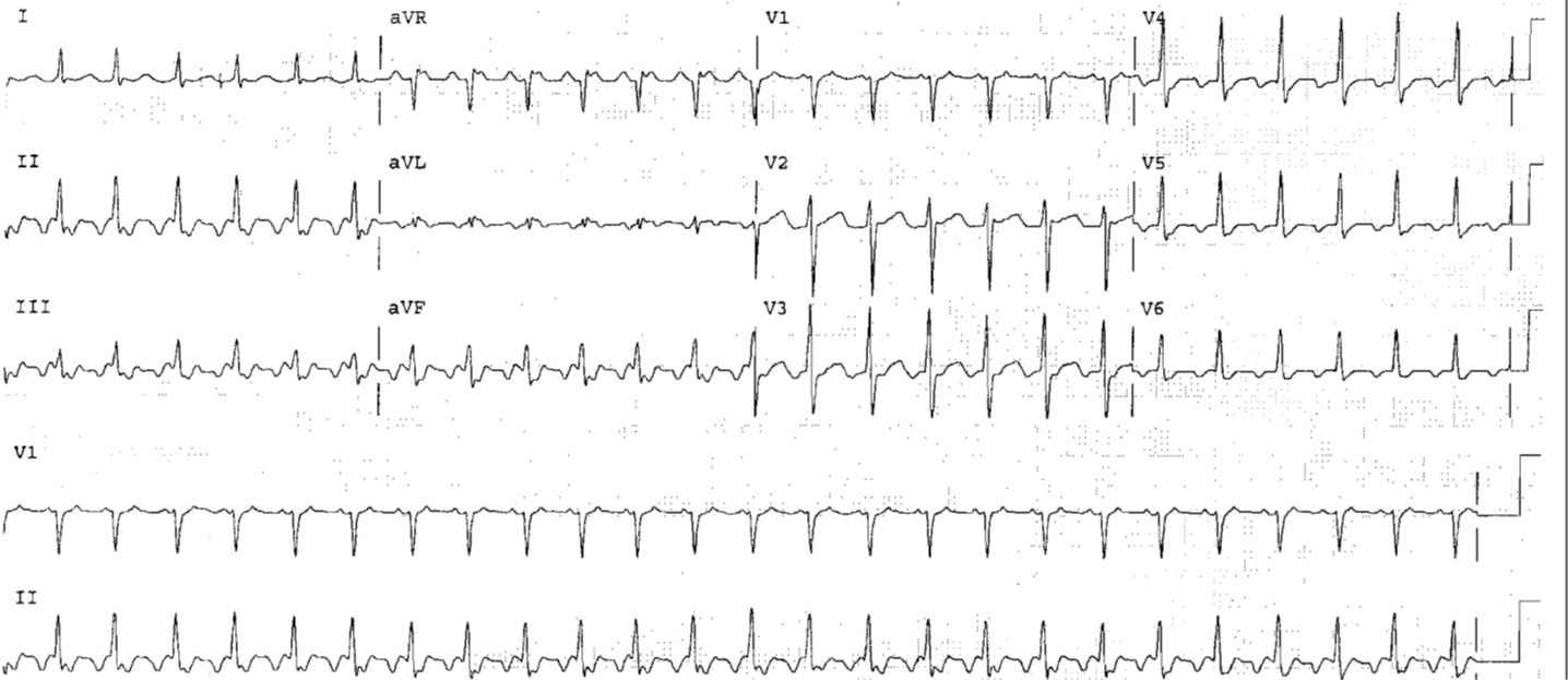 atrial flutter 2 to 1 conduction