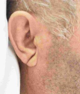 Read more about the article A Diagonal Crease in Each Earlobe