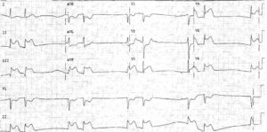 Read more about the article ECG Case 25