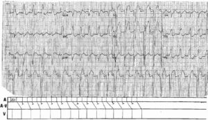 Read more about the article LBBB and Atrial Flutter with 2:1 and 3:2 Conduction