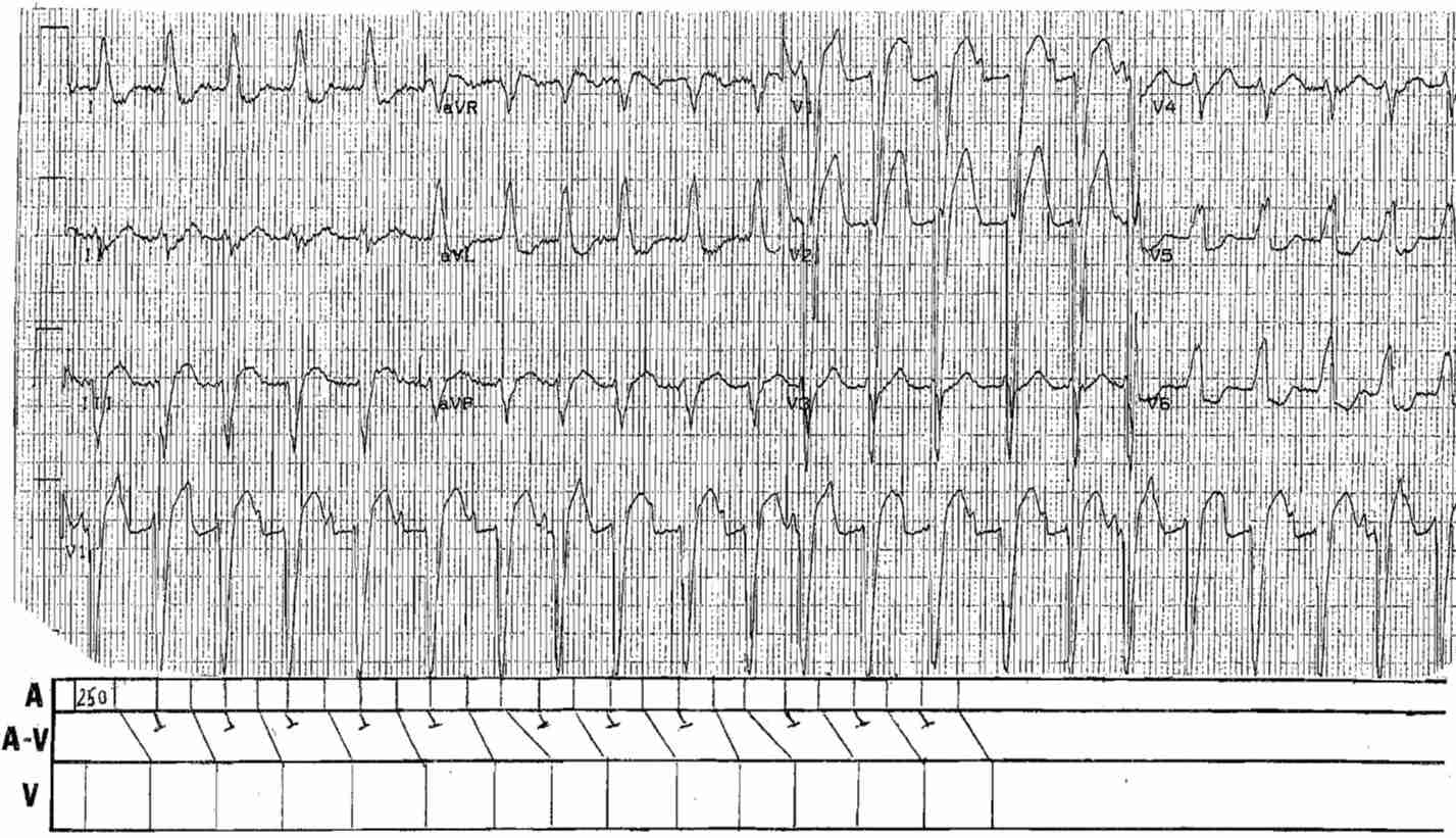 LBBB and Atrial Flutter with 2:1 and 3:2 Conduction