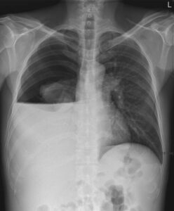 Read more about the article Patient with Shortness of Breath and Cirrhosis