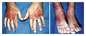 Read more about the article Patient with a 1-day history of fever, symmetric polyarthritis, abdominal pain, and hematemesis