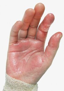 Read more about the article Rash on hand after cesarean section in association with fever and hypotension