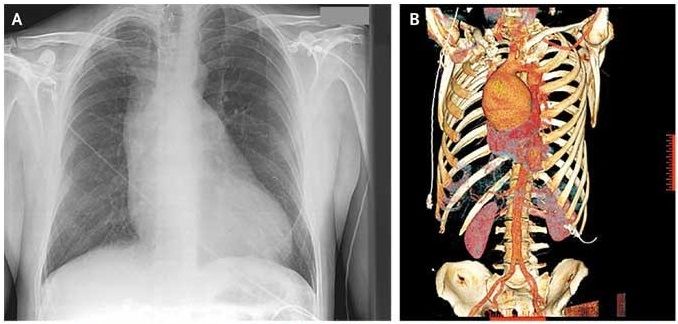 Chest radiography revealed a widened mediastinum (Panel A).  3-D reconstruction computed tomographic angiography of the chest showed a 9.5-cm ascending aortic aneurysm (Panel B)
