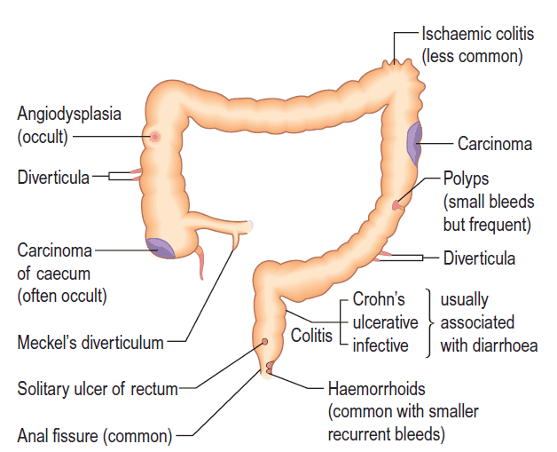 Causes of lower gastrointestinal bleeding
