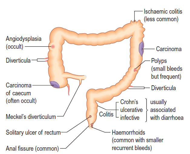 Sthanu on X: Unusual cause of lower GI bleed! ♦️ abdominal pain