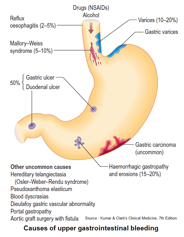 Read more about the article Hematemesis, Hematochezia, and Melena – Differential Diagnosis, Examination and Investigations