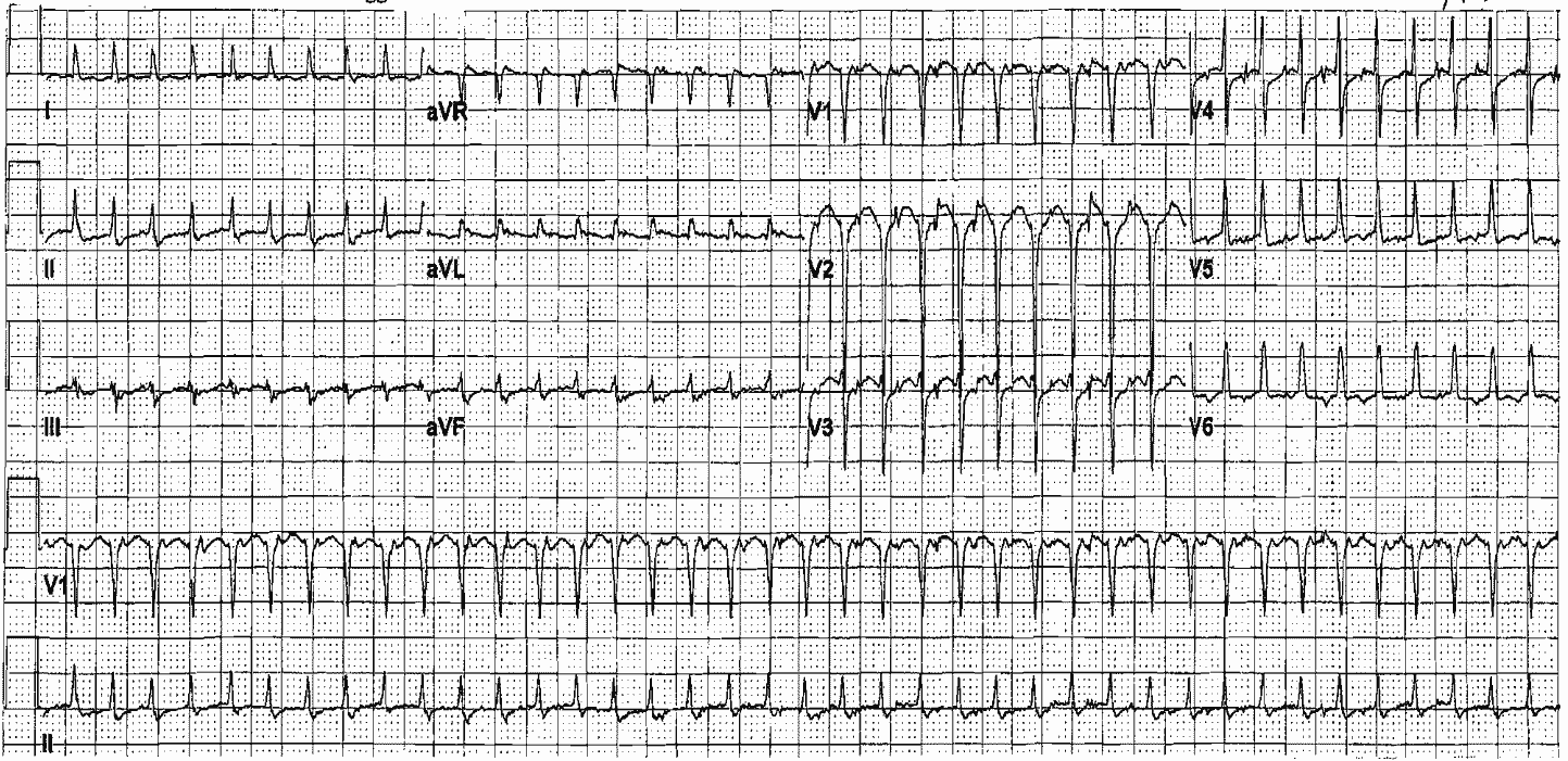 Read more about the article ECG Case 31