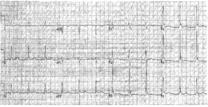 Read more about the article ECG Case 32