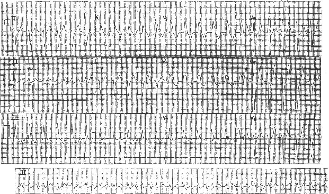 Read more about the article ECG Case 34