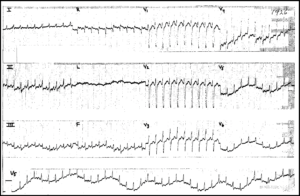 Read more about the article Atrial Flutter with 1:1 conduction then 2:1 conduction