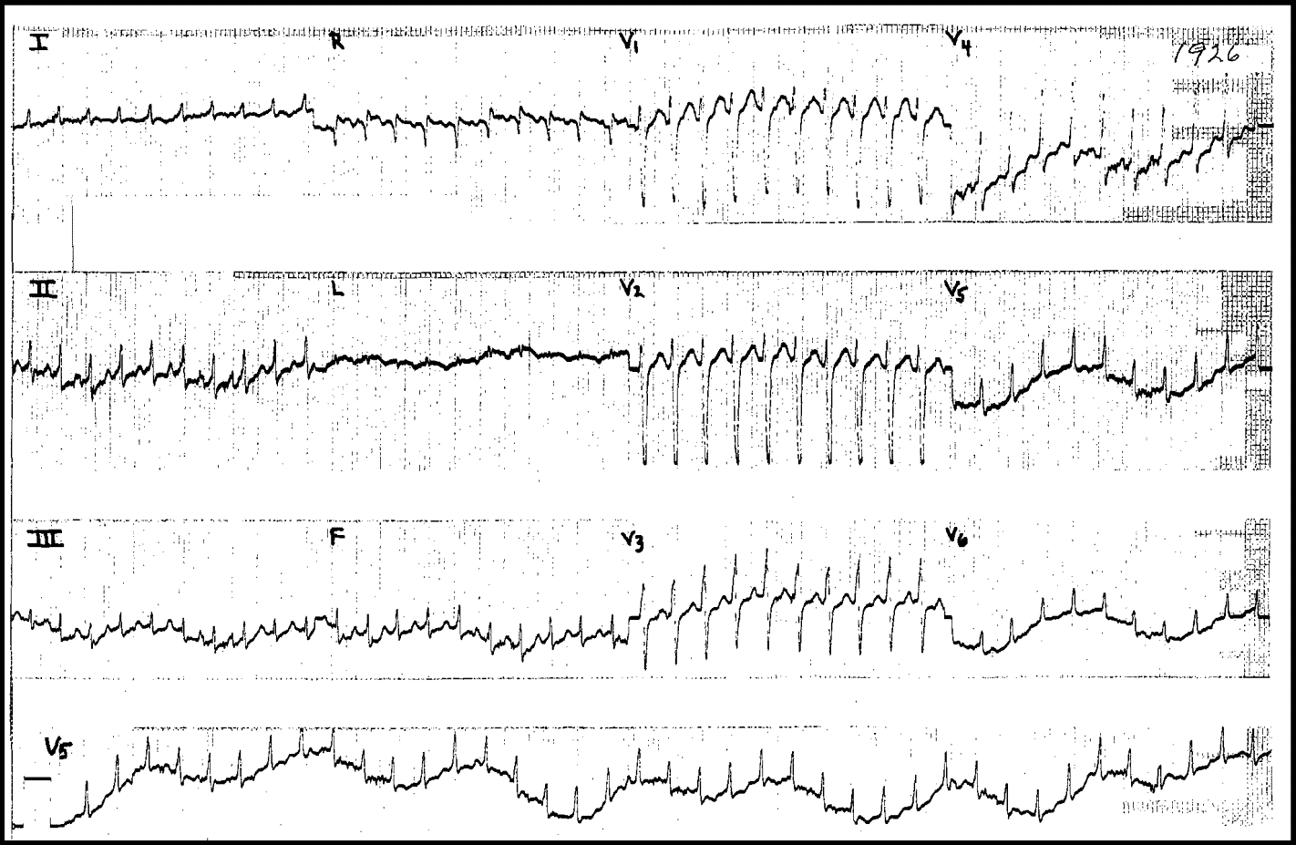 Atrial Flutter with 1:1 conduction