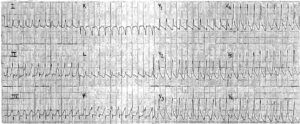 Read more about the article ECG Case 33