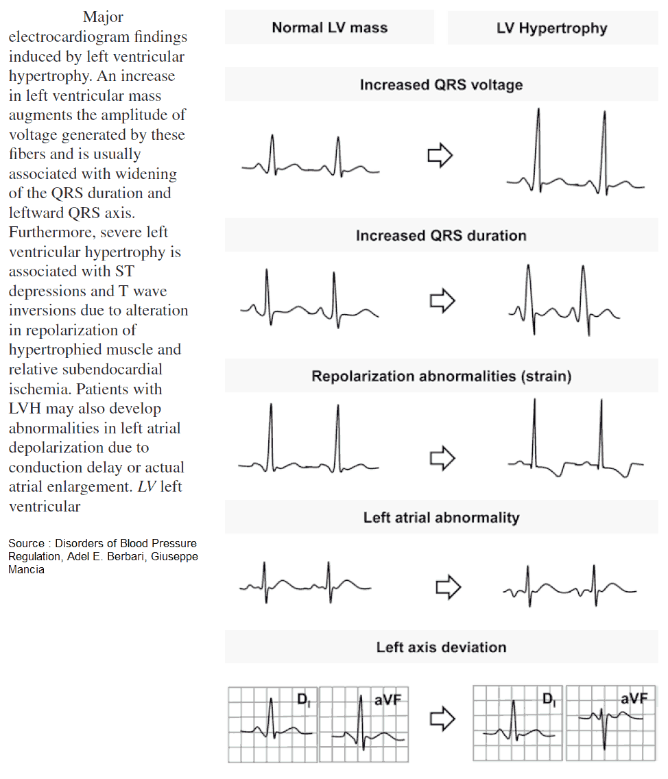 Major electrocardiogram findings induced by left ventricular hypertrophy