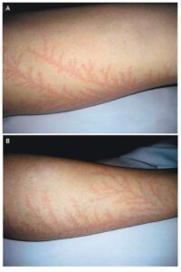 Read more about the article Painless Erythematous Cutaneous Marks in a Fern-Leaf Pattern