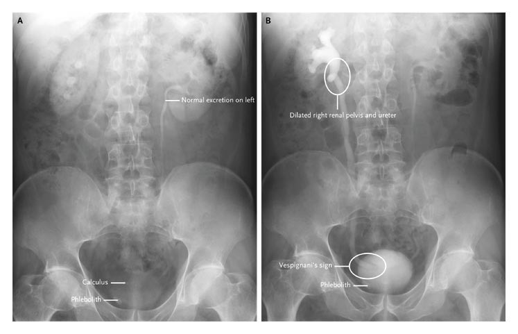 Urinary calculus at the right uretero-vesical junction