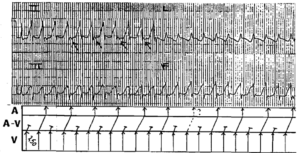Read more about the article Ventricular Tachycardia in 69 year-old man