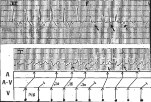 Read more about the article Ventricular Tachycardia with Retrograde 4:3 Wenckebach Conduction