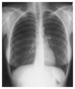 Read more about the article Catamenial Pneumothorax (Thoracic Endometriosis) in 38-year-old Woman