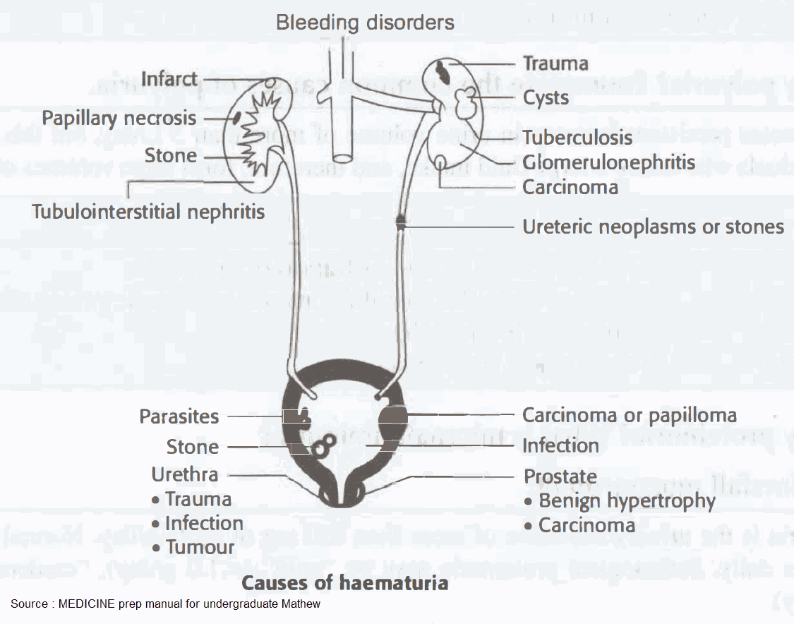 Causes of haematuria