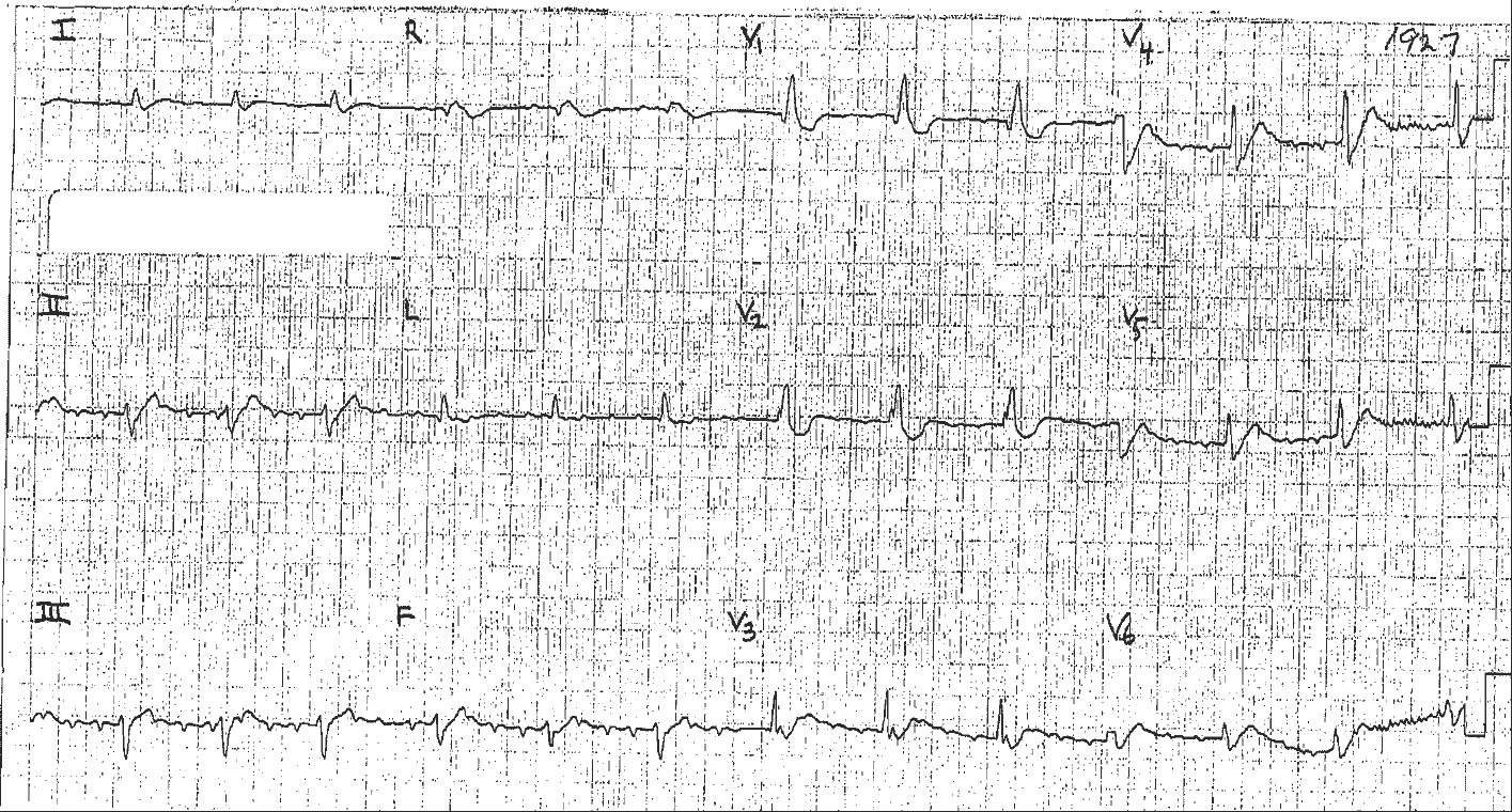 Hypercalcemia and Atrial Flutter with 3:1 Conduction