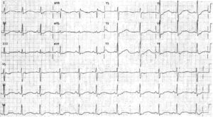 Read more about the article ECG Case 37