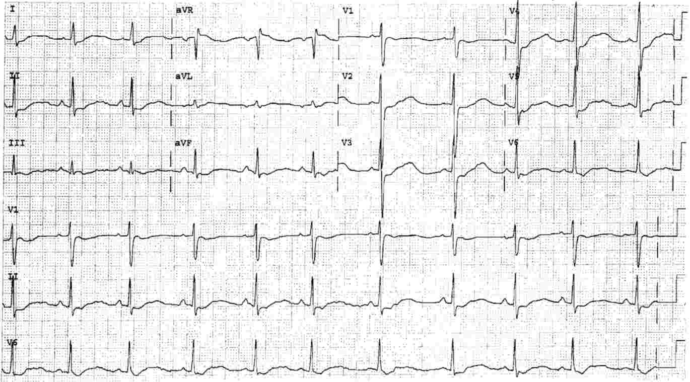 ECG of Hypokalemia with Long QT (QU interval) interval, U waves and widespread ST depression due to familial hypokalemic paralysis