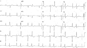 Read more about the article ECG Case 38